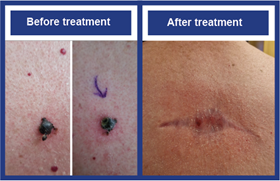 skin cancer AI Broadgreen Hospital