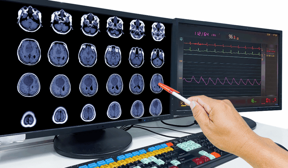 Clatterbridge leads the way with research into new treatment for brain cancer
