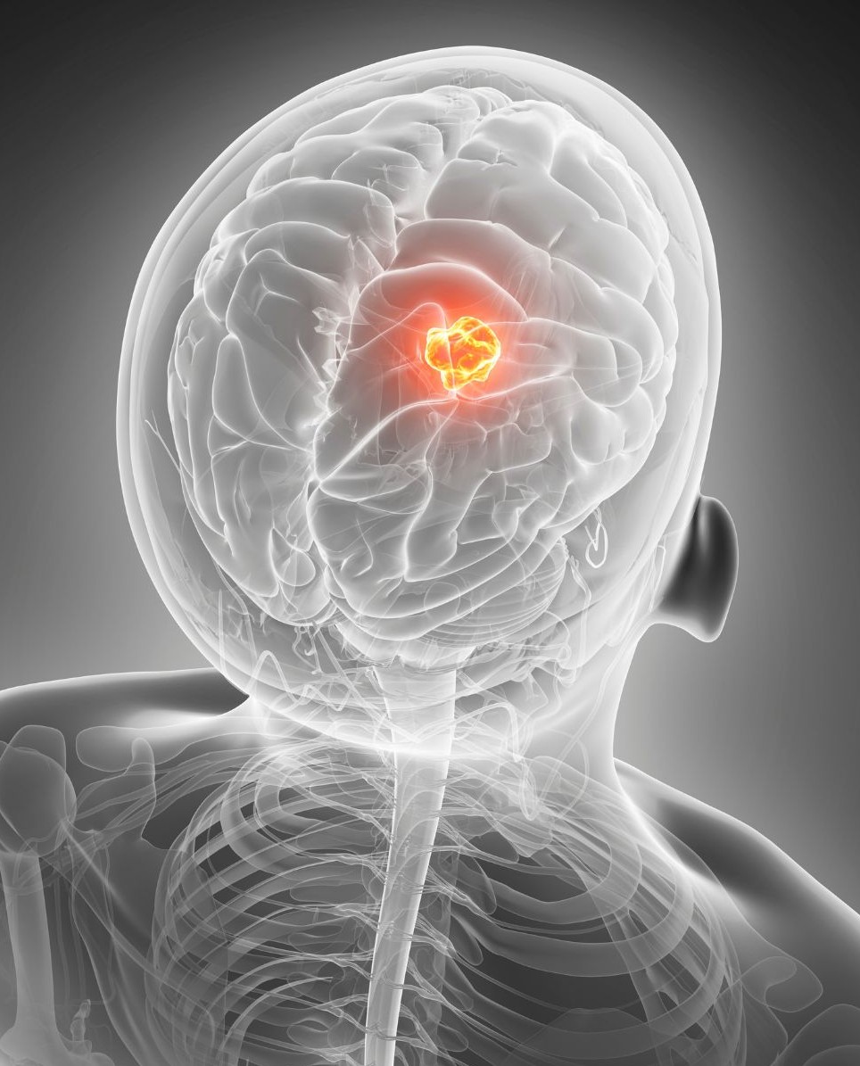 Clatterbridge - Brain Cancer